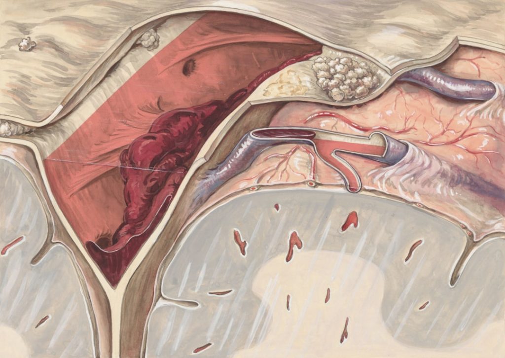 Illustration of peripheral artery disease showing blocked artery and blood flow