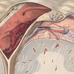 Illustration of peripheral artery disease showing blocked artery and blood flow